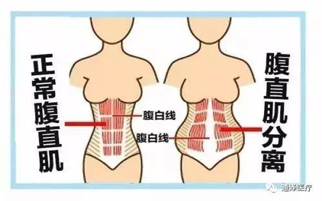 盆底恢復,產后恢復項目,產后快速恢復